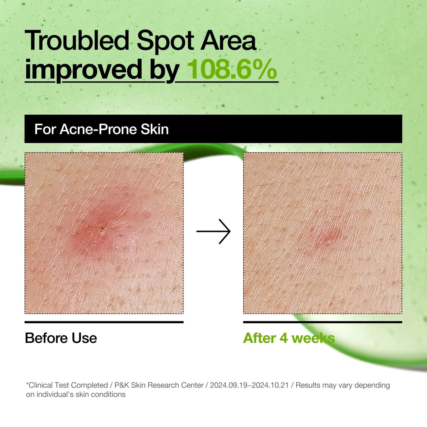 Anua Azelaic Acid 10 Serum - Redness Care 30ml