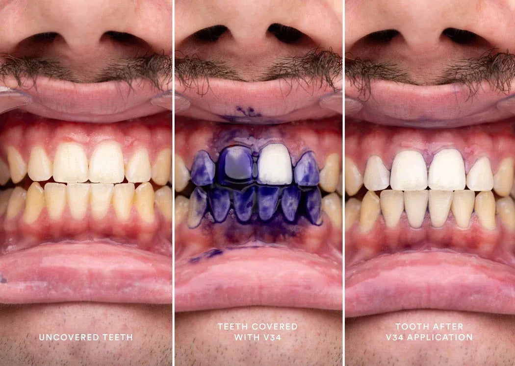 V34 Hi-Smile Teeth Whitener